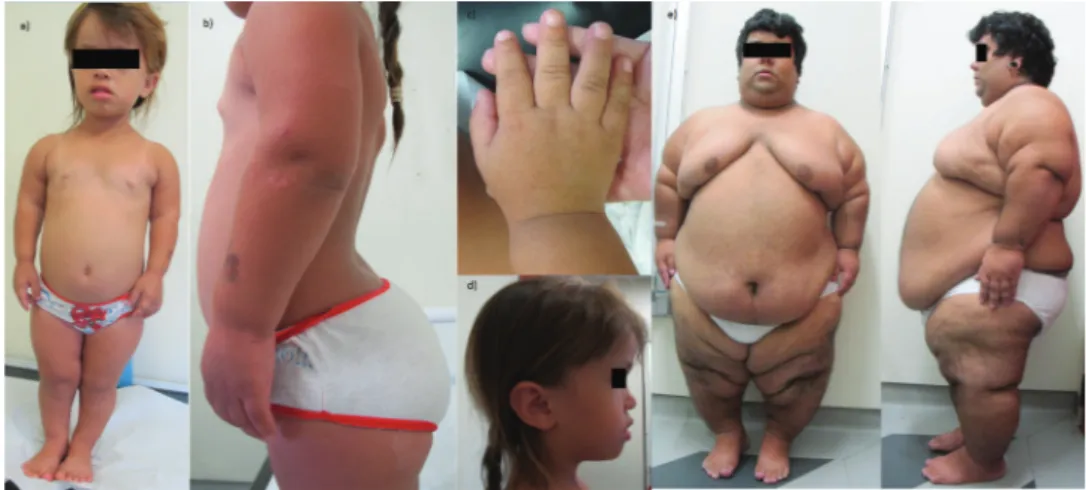 Figure 1 - Clinical findings in two achondroplastic patients. a-c) The clinical findings in a 6-year-old female patient