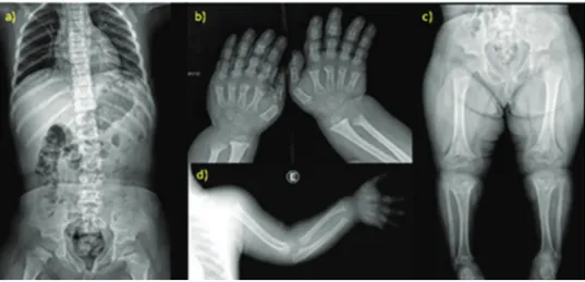 Figure 2 - Radiological findings of achondroplasia. a-d) X-ray studies of a 5-year-old patient