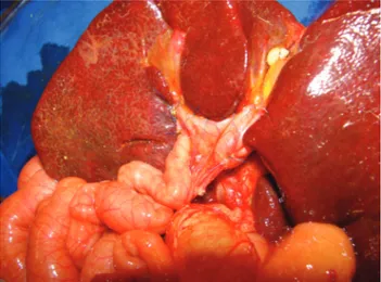 Figure 2 - Final aspect of the surgery. Note the Roux-en-Y jejunal loop draining the transected porta hepatis.