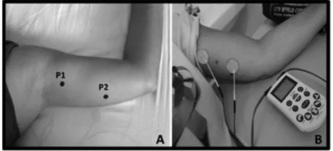Figure 1  - A- Points of skin sensitivity assessment and  TENS electrodes placement. B- TENS application at the ICBN  dermatome.