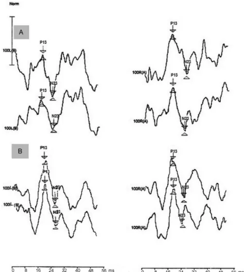Fig. 1 Representative illustration of the biphasic cVEMPs waveforms (P13 and N23) recorded from two toddlers in response to 500 Hz tone bursts at an intensity of 100 dBnHL