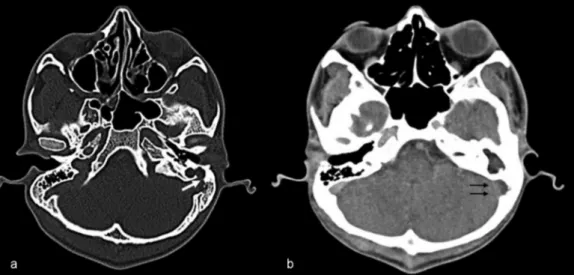 Fig. 1 (A) Computed tomography (CT) brain bone window axial cut showing the density of the soft tissue in the middle ear with a breach of the sigmoid plate (arrow) with cavitation of the mastoid air cell system