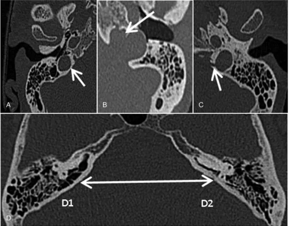Fig. 1 Computed axial tomography images showing anatomical variations of the temporal bone: (A) High jugular bulb, above the level of the tympanic annulus (arrow); (B) Jugular bulb diverticulum (arrow); (C) Contact between the jugular bulb and the vestibul