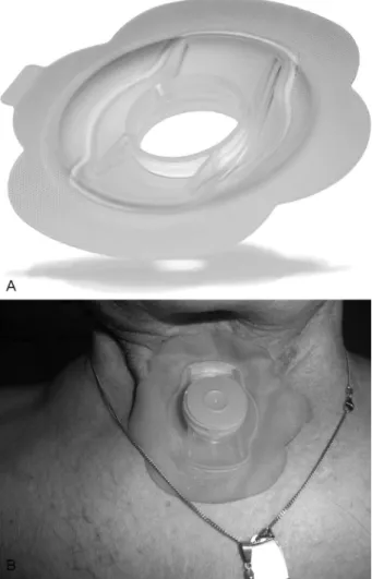 Fig. 1 StabiliBase OptiDerm (SBO); (A) a technical drawing of the SBO without liner (frontal view) showing the stable and conical base; (B) attached to a patient with the heat and moisture exchanger in situ.