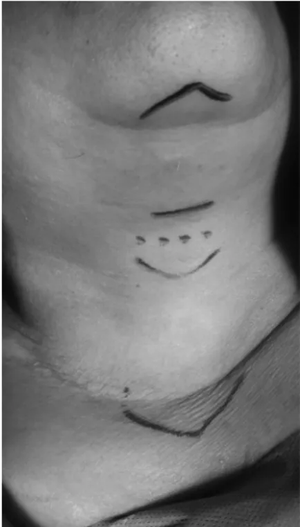 Fig. 2 The thyroid cartilage (T) and the anterior surface of the hyoid bone (H) were exposed.