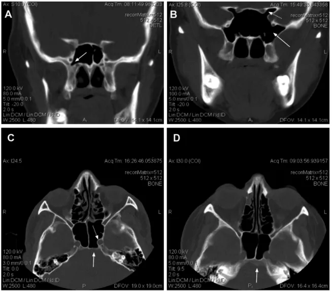 Fig. 2 (A) Coronal plane, protrusion of parasellar segment of the internal carotid artery (psICA) and lateral extension of the sphenoid sinus.