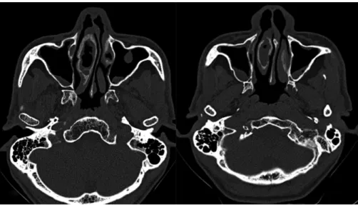 Fig. 1 (a and b) Axial sections of computed tomography of the paranasal sinuses showing mucosal thickening within the right concha bullosa, and thickening of the surrounding bony walls