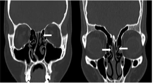 Fig. 4 (a and b) Coronal sections of non-contrast computed tomography scan of the paranasal sinuses showing pneumatized vertical lamella of left middle turbinate (lamellar type of concha shown with arrow)