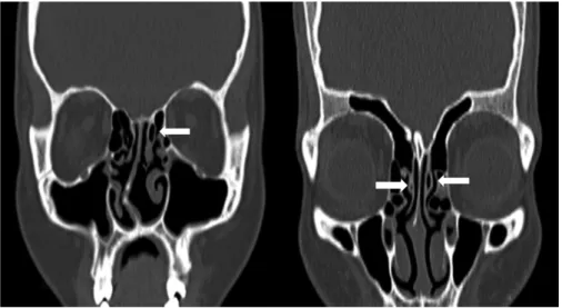 Fig. 4 (a and b) Coronal sections of non-contrast computed tomography scan of the paranasal sinuses showing pneumatized vertical lamella of left middle turbinate (lamellar type of concha shown with arrow)