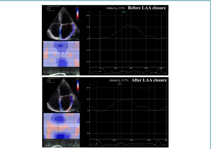 Figure 1 - Global left atrial strain during reservoir phase (ƐR) before and after percutaneous closure of the left atrial appendage (LAA)
