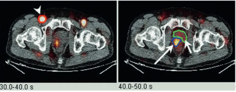 Figure 1 -  11 C-choline PET / CT dynamic blood flow. Axial fused PET / CT sequential blood flow images (left: 30-40 seconds after  injection; right: 40-50 seconds after injection) showing preferential arterial supply to the prostate tumor relative to back