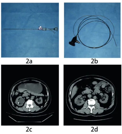 Figure 2a) One adapter attached to the tip of the outer shaft; 2b) The 0.7-mm fiber-endoscope of the flexible ureterorenoscope; 