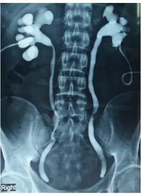 Figure 1 - Nephrostomogram showing complete cut off at  the level of lower ureter on both sides (done after being  operated elsewhere).