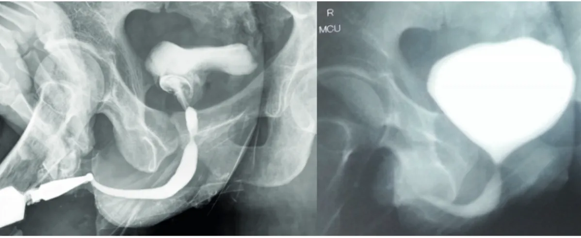 Figure 3 - Ascending cysto-urethrogram and MCU showing normal anterior urethra and a smooth walled small capacity  bladder (which in retrospect was actually the prostatic utricle cyst).