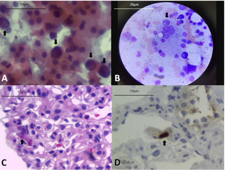 Figura 1. A) células urinárias decoy (Papanicolaou). B) Hemofagocitose no aspirado de medula óssea (Giemsa)