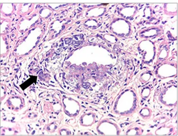 Figure 3. Inflammatory process area in granulomatous pattern, with  giant multinucleated cell (arrow), interspersed by foci of dystrophic  calcification, arranged around tubular structure (H &amp; E - 100x)