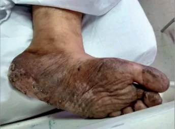 Figure 1. Hyperchromic lesions with altered sensitivity more evident  on the soles of the feet.