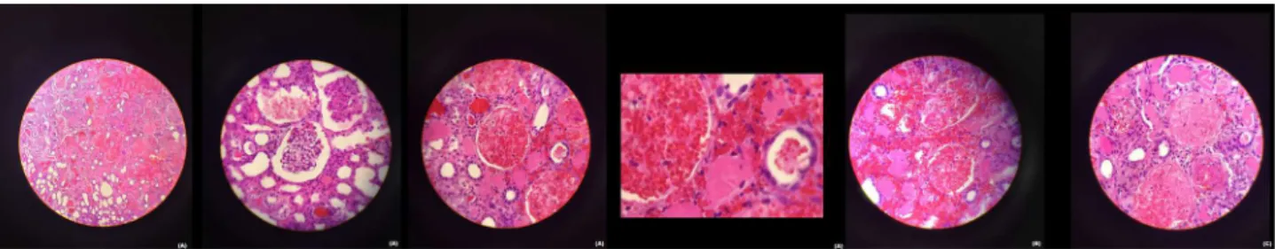 Figure 2. Renal Biopsy: extensive areas of ischemic and hemorrhagic infarction (A), interstitial hemorrhage (B), and fibrin thrombi in medium-sized vessels (C).