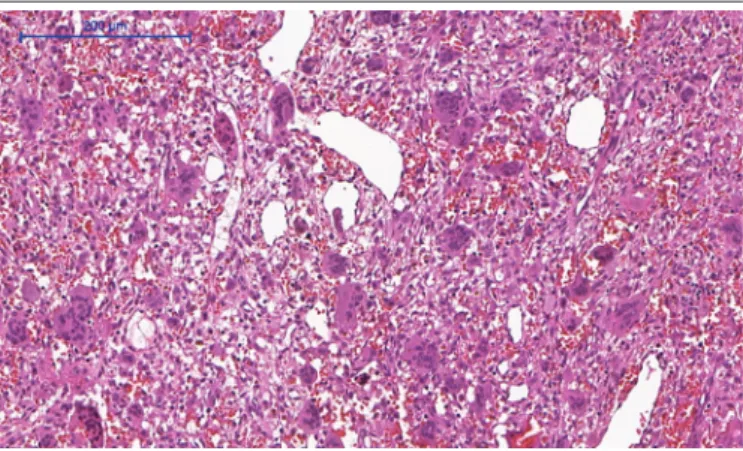 FIGURE 1  − Microscopic aspects of CGCG: proliferation of mononuclear mesenchymal  cells associated with a population of multinucleated giant cells in a matrix of dense fibrous  conjunctive tissue, presenting extravasated red blood cells (HE, 200 µm)