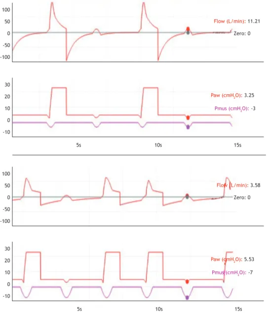 Figure 1. Flow and pressure waveforms, respectively, illustrating two simulated types of ineffective triggering