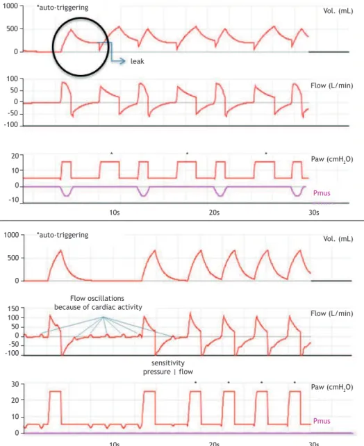 Figure 2. Volume, ﬂ ow and pressure waveforms, respectively, illustrating two simulated types of auto-triggering