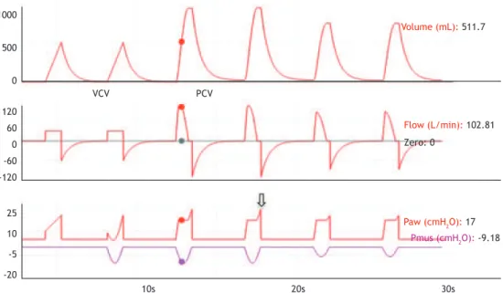 Figure 5.  Volume, ﬂ ow, and pressure waveforms, respectively, illustrating simulation of correction of ﬂ ow asynchrony  and volume asynchrony (air hunger), evident in the second breath, during VCV