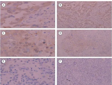 Table 2 shows that ENO1 expression was significantly  higher in the lung cancer group (50.0%) than that in  the benign lung disease group (10.0%), the difference  being statistically significant (χ 2  = 24.137; p < 0.001)