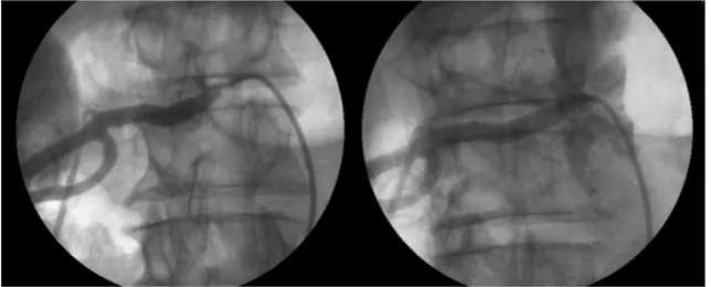 Figura 1. Primeira reestenose intra-stent renal. Angiografias pré e pós-reintervenção, sendo realizado implante de stent coaxial de  7 × 19 mm.