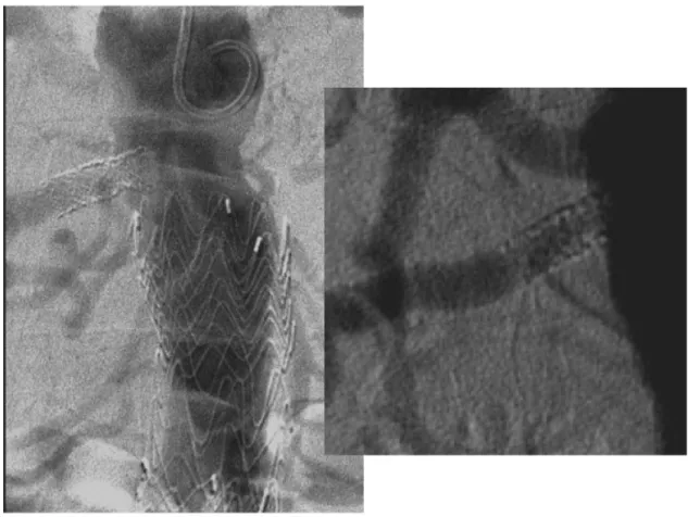 Figura 2. Aortografia por acesso braquial evidenciando sinais de hiperplasia intra-stent que confirmam o achado do mapeamento  dúplex.
