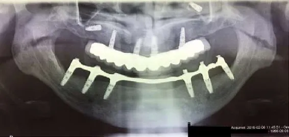 Figura 7: Ortopantomografia revelando um implante no seio maxilar direito sob a membrane de  Scheneider e outro livre no seio maxilar esquerdo 