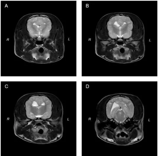 Figure 10 – Transverse T2-weighted images at the level of the caudate nucleus (A and B)  interthalamic adhesion (C) and mesencephalic aqueduct (D)