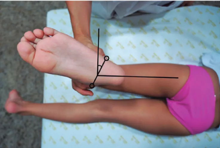 Figure 2. Clinical assessment of the tibial torsion using the transmalleolar axis