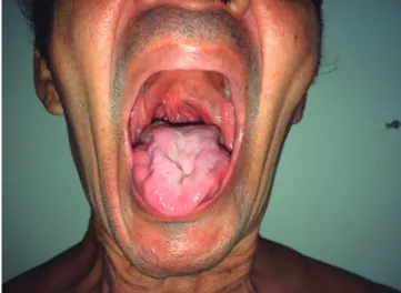 Figura 1. Atrofia da língua e desvio da úvula para direita