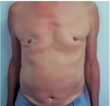 Figure 2. Surgical scars as a result of gynecomastia correction Table 1. Cases of Kennedy’s disease described in Brazil
