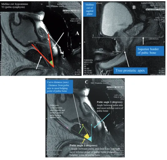 Figure 1 - Anthropometric measurements by magnetic resonance imaging. (A) angle between the pubic bone and the  prostate gland in midline cut: hypointense T2 (pubic symphysis); B) depth of prostatic apex; C) curve of public bone.