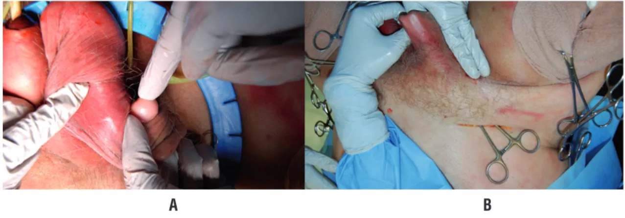 Figure 1 - A) Standard pump placement through counter incision B) Pump placement into sub-dartos pouch through  perineal incision into the same space.