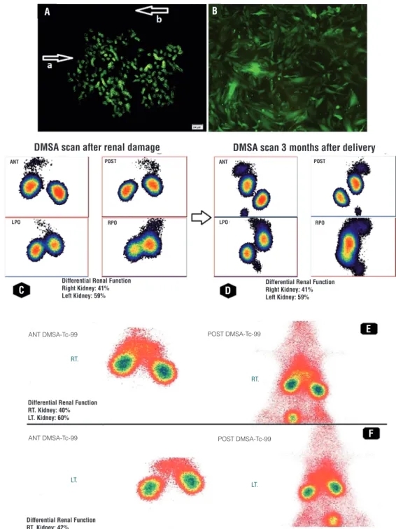 Figure 1 - (A) Immunofluorescence of damaged part of maternal non-GFP kidney. Arrow a shows the damaged part of  maternal kidney which is covered by GFP-positive FSCs