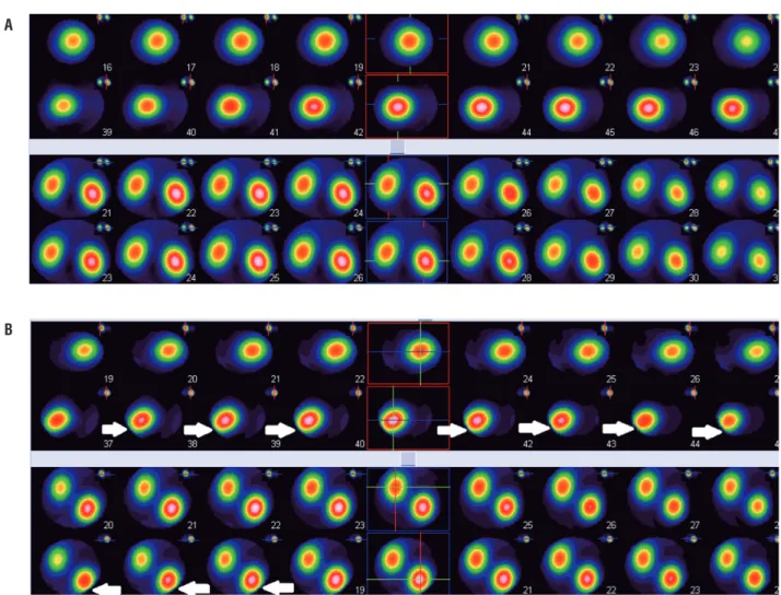 Figure 2 - (A) SPECT in the experimental group three months after delivery showed satisfactory results without any significant  impairment as compared with control group; (B) SPECT in the control group showed that the renal injury persisted after  three mo