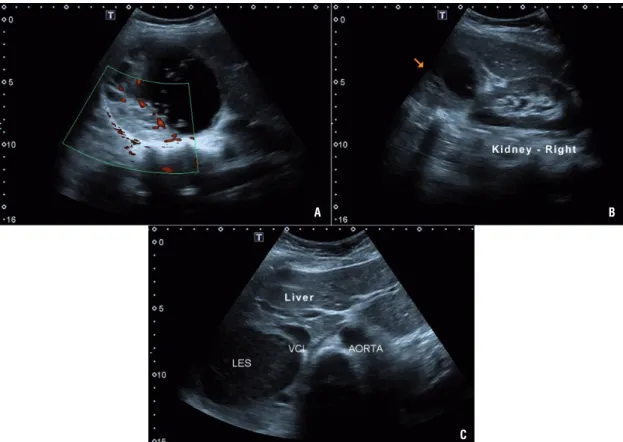 Figure 1 - A) Ultrasound showing right adrenal tumor with more than 10 centimeters, with mixed cystic-solid components and  doppler imaging confirm the presence of vascular flow; B) Arrow indicating the great mass between the liver (Liver) and the  right k