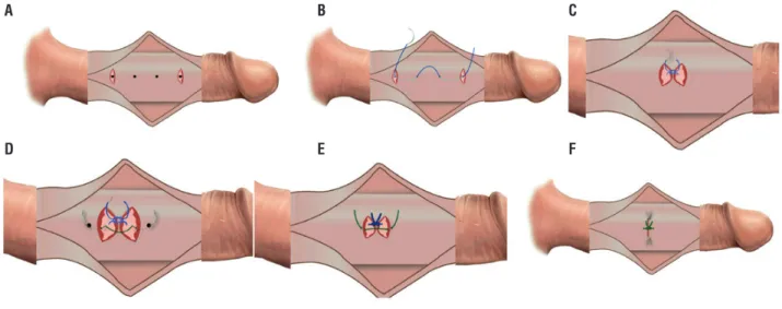 Figure 1 - Diagrammatic steps of CPI technique 1A) Two transverse incisions through outer layer of tunica albuginea at first  and last dots
