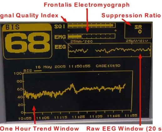 Figure 1.2  - This figure adapted from Johansen J. 2000 represents a BIS display screen