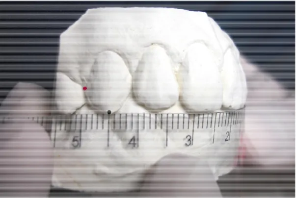 Figura 11: Para medir distância entre as cúspides dos caninos superiores (TTC), ponto preto, e  entre as faces distais dos mesmos dentes (DDC), ponto vermelho
