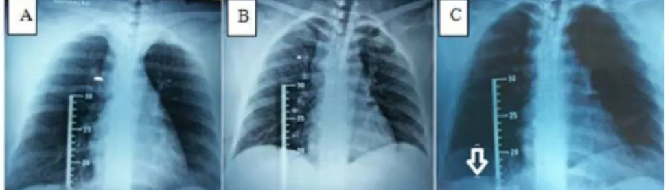 Figura 1. Radiografias de tórax, em incidência AP, em máxima expiração sobre em máxima  inspiração, utilizando como referência a imagem da régua radiográfica