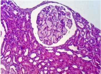 Figura 1. Glomerulopatia por lipoproteínas: glomérulos aumentados  com material eosinofílico claro na luz capilar