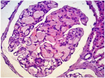 Figura 2. Glomerulopatia por lipoproteínas: alças capilares dilatadas  exibindo trombos de lipoproteína eosinofílicos na luz capilar