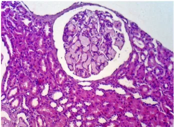 Figure 1. Lipoprotein glomerulopathy: A large glomeruli showing a  pale eosinophilic material in the capillary lumina