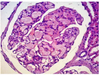 Figure 2. Lipoprotein glomerulopathy: Dilated capillary loops  exhibiting an eosinophilic lipoprotein thrombi in the capillary lumina