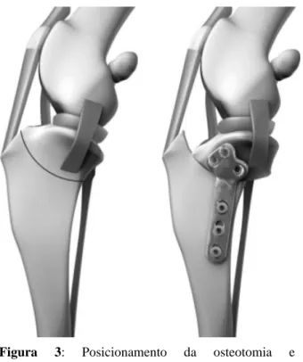 Figura  3:  Posicionamento  da  osteotomia  e  representação esquemática da técnica TPLO (adaptado  de Kim el al., 2008)