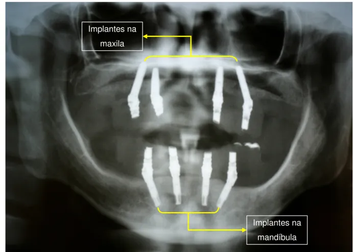 Figura 1.1: Caso clínico implantes na maxila e na mandíbula – “All  on  four” (Gomes et al.,  2008)