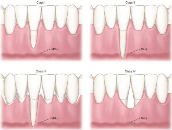 Figura 1 – Classificação de Miller. Adaptada de (Sturdevant's Art &amp; Science of Operative Dentistry,  2002)